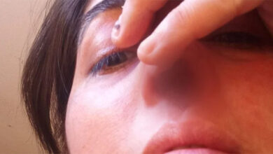 Photo of Caleta Olivia: perdió el cartilago de la nariz por un hisopado