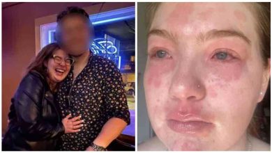 Photo of Una joven descubrió que es alérgica a su novio